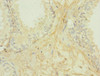 Immunohistochemistry of paraffin-embedded human prostate cancer using CSB-PA009438ESR2HU at dilution of 1:100