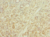 Immunohistochemistry of paraffin-embedded human pancreatic cancer using CSB-PA731055ESR2HU at dilution of 1:100