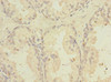 Immunohistochemistry of paraffin-embedded human prostate cancer using CSB-PA023992ESR2HU at dilution of 1:100