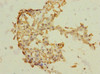 Immunohistochemistry of paraffin-embedded human breast cancer using CSB-PA890740ESR1HU at dilution of 1:100