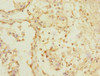 Immunohistochemistry of paraffin-embedded human breast cancer using CSB-PA890740ESR2HU at dilution of 1:100