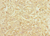 Immunohistochemistry of paraffin-embedded human pancreatic cancer using CSB-PA010289ESR1HU at dilution of 1:100