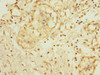 Immunohistochemistry of paraffin-embedded human breast cancer using CSB-PA892455ESR1HU at dilution of 1:100