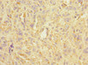 Immunohistochemistry of paraffin-embedded human melanoma using CSB-PA890688ESR1HU at dilution of 1:100
