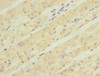Immunohistochemistry of paraffin-embedded human gastric cancer using CSB-PA865174ESR2HU at dilution of 1:100
