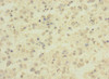 Immunohistochemistry of paraffin-embedded human glioma using CSB-PA002541ESR1HU at dilution of 1:100