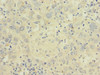 Immunohistochemistry of paraffin-embedded human liver cancer using CSB-PA889145ESR2HU at dilution of 1:100