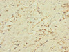 Immunohistochemistry of paraffin-embedded human gastric cancer using CSB-PA004944ESR2HU at dilution of 1:100