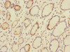 Immunohistochemistry of paraffin-embedded human colon cancer using CSB-PA005164ESR1HU at dilution of 1:100