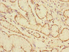 Immunohistochemistry of paraffin-embedded human colon cancer using CSB-PA005164ESR2HU at dilution of 1:100