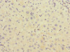 Immunohistochemistry of paraffin-embedded human liver cancer using CSB-PA005400ESR1HU at dilution of 1:100