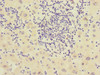 Immunohistochemistry of paraffin-embedded human liver cancer using CSB-PA005400ESR2HU at dilution of 1:100