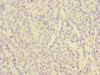 Immunohistochemistry of paraffin-embedded human ovarian cancer using CSB-PA008542ESR2HU at dilution of 1:100