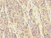 Immunohistochemistry of paraffin-embedded human ovarian cancer using CSB-PA718779ESR2HU at dilution of 1:100