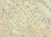 Immunohistochemistry of paraffin-embedded human gastric cancer using CSB-PA623779ESR2HU at dilution of 1:100