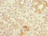 Immunohistochemistry of paraffin-embedded human pancreatic cancer using CSB-PA013099ESR2HU at dilution of 1:100