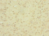 Immunohistochemistry of paraffin-embedded human glioma using CSB-PA844701ESR2HU at dilution of 1:100