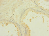 Immunohistochemistry of paraffin-embedded human prostate cancer using CSB-PA888028ESR1HU at dilution of 1:100