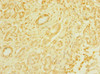 Immunohistochemistry of paraffin-embedded human pancreatic cancer using CSB-PA752534ESR2HU at dilution of 1:100