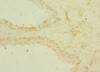 Immunohistochemistry of paraffin-embedded human prostate cancer using CSB-PA863139ESR1HU at dilution of 1:100