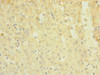 Immunohistochemistry of paraffin-embedded human liver cancer using CSB-PA857013ESR2HU at dilution of 1:100