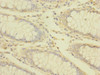 Immunohistochemistry of paraffin-embedded human colon cancer using CSB-PA857013ESR2HU at dilution of 1:100