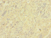 Immunohistochemistry of paraffin-embedded human liver cancer using CSB-PA006076ESR1HU at dilution of 1:100