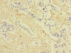 Immunohistochemistry of paraffin-embedded human pancreatic cancer using CSB-PA005498ESR1HU at dilution of 1:100