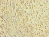 Immunohistochemistry of paraffin-embedded human gastric cancer using CSB-PA005498ESR2HU at dilution of 1:100