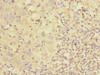 Immunohistochemistry of paraffin-embedded human liver cancer using CSB-PA880995DSR1HU at dilution of 1:100