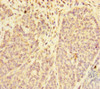 Immunohistochemistry of paraffin-embedded human ovarian cancer using CSB-PA2109ESR1HU at dilution of 1:100