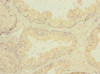 Immunohistochemistry of paraffin-embedded human prostate cancer using CSB-PA019640ESR2HU at dilution of 1:100