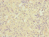 Immunohistochemistry of paraffin-embedded human liver cancer using CSB-PA004421ESR1HU at dilution of 1:100