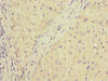 Immunohistochemistry of paraffin-embedded human liver cancer using CSB-PA897321ESR1HU at dilution of 1:100