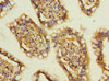 Immunohistochemistry of paraffin-embedded human colon cancer using CSB-PA618762ESR2HU at dilution of 1:100