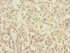 Immunohistochemistry of paraffin-embedded human gastric cancer using CSB-PA014817ESR1HU at dilution of 1:100