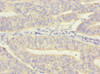 Immunohistochemistry of paraffin-embedded human endometrial cancer using CSB-PA014817ESR1HU at dilution of 1:100