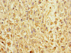 Immunohistochemistry of paraffin-embedded human melanoma using CSB-PA857021ESR1HU at dilution of 1:100