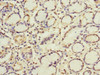 Immunohistochemistry of paraffin-embedded human gastric cancer using CSB-PA846077ESR1HU at dilution of 1:100