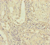 Immunohistochemistry of paraffin-embedded human lung cancer using CSB-PA018107ESR1HU at dilution of 1:100