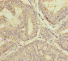 Immunohistochemistry of paraffin-embedded human endometrial cancer using CSB-PA018107ESR1HU at dilution of 1:100