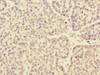 Immunohistochemistry of paraffin-embedded human ovarian cancer using CSB-PA878863ESR2HU at dilution of 1:100