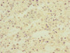 Immunohistochemistry of paraffin-embedded human glioma using CSB-PA861078ESR1HU at dilution of 1:100