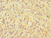 Immunohistochemistry of paraffin-embedded human melanoma using CSB-PA623095DSR1HU at dilution of 1:100