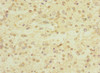 Immunohistochemistry of paraffin-embedded human glioma using CSB-PA619860ESR1HU at dilution of 1:100