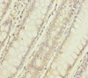 Immunohistochemistry of paraffin-embedded human colon cancer using CSB-PA617948ESR1HU at dilution of 1:100