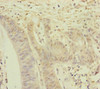 Immunohistochemistry of paraffin-embedded human colon cancer using CSB-PA617948ESR2HU at dilution of 1:100
