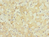 Immunohistochemistry of paraffin-embedded human liver cancer using CSB-PA009283ESR1HU at dilution of 1:100