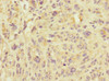 Immunohistochemistry of paraffin-embedded human melanoma using CSB-PA822306ESR1HU at dilution of 1:100