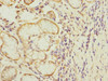 Immunohistochemistry of paraffin-embedded human gastric cancer using CSB-PA822201ESR1HU at dilution of 1:100
